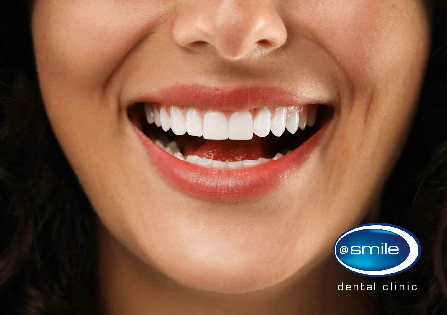 29% off Professional Teeth Whitening @Smile Dental Clinic