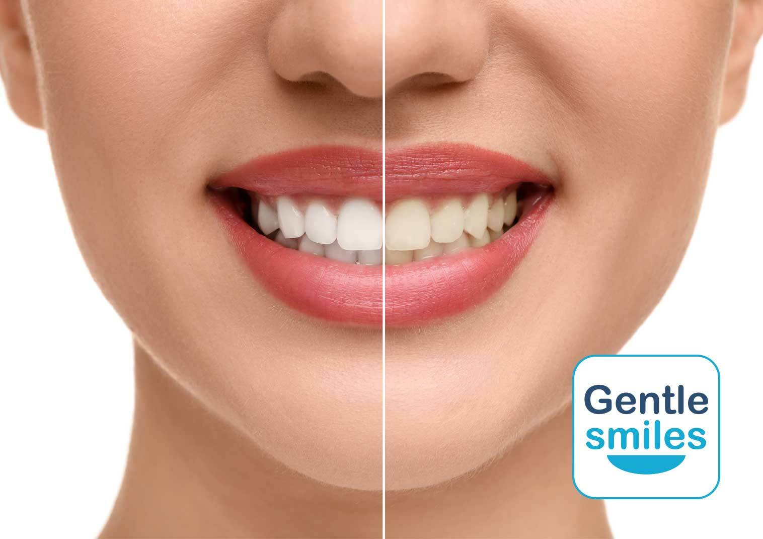 29% off Professional Teeth Whitening at Gentle Smiles