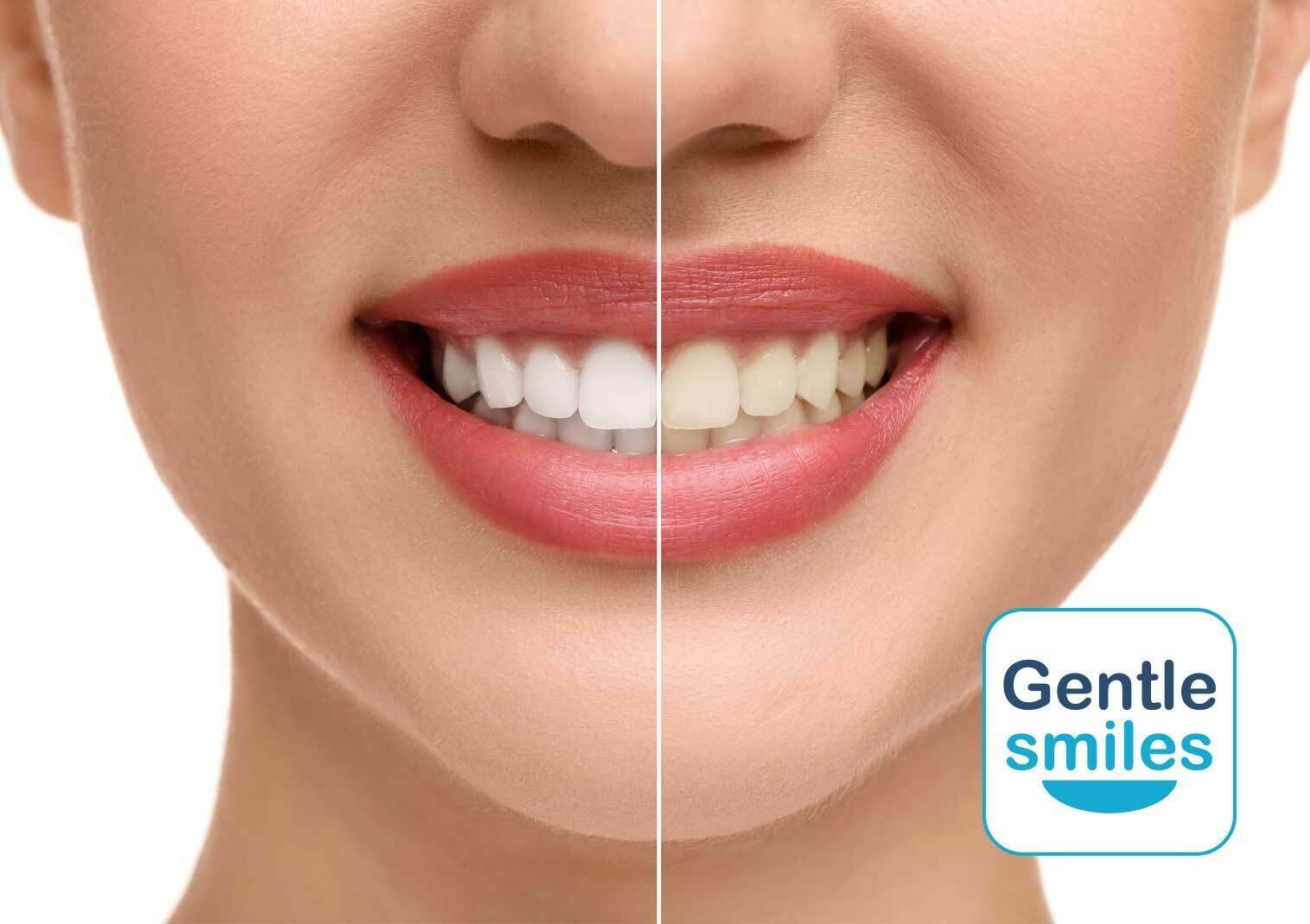 29% off Professional Teeth Whitening at Gentle Smiles