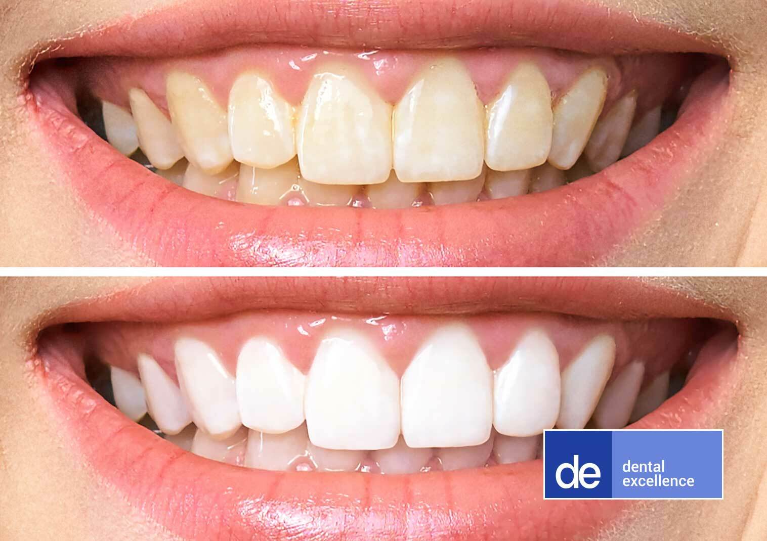 29% off Professional Teeth Whitening at Dental Excellence